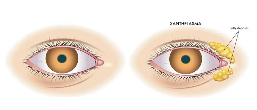 Biji Kolesterol Malaysia Cara Rawat E1771902938580