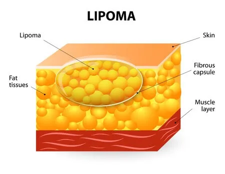 Lipoma Excision In MA 1