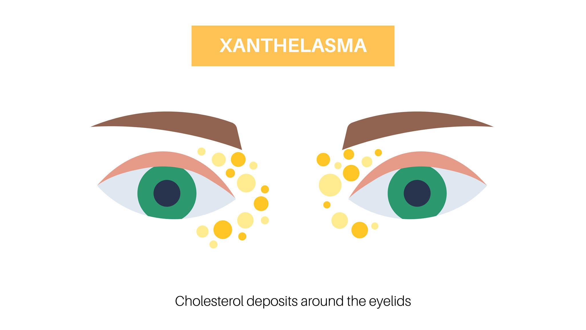 xanthelasma tompok kunin